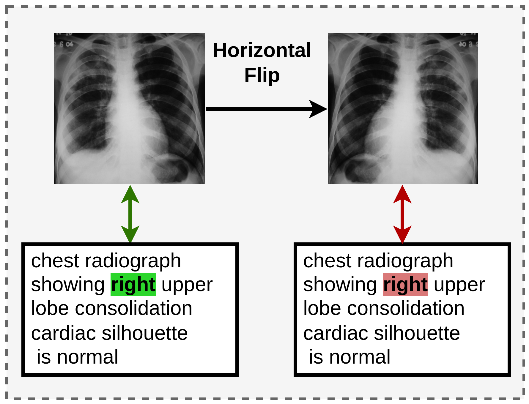 Foreign objects in chest X-rays