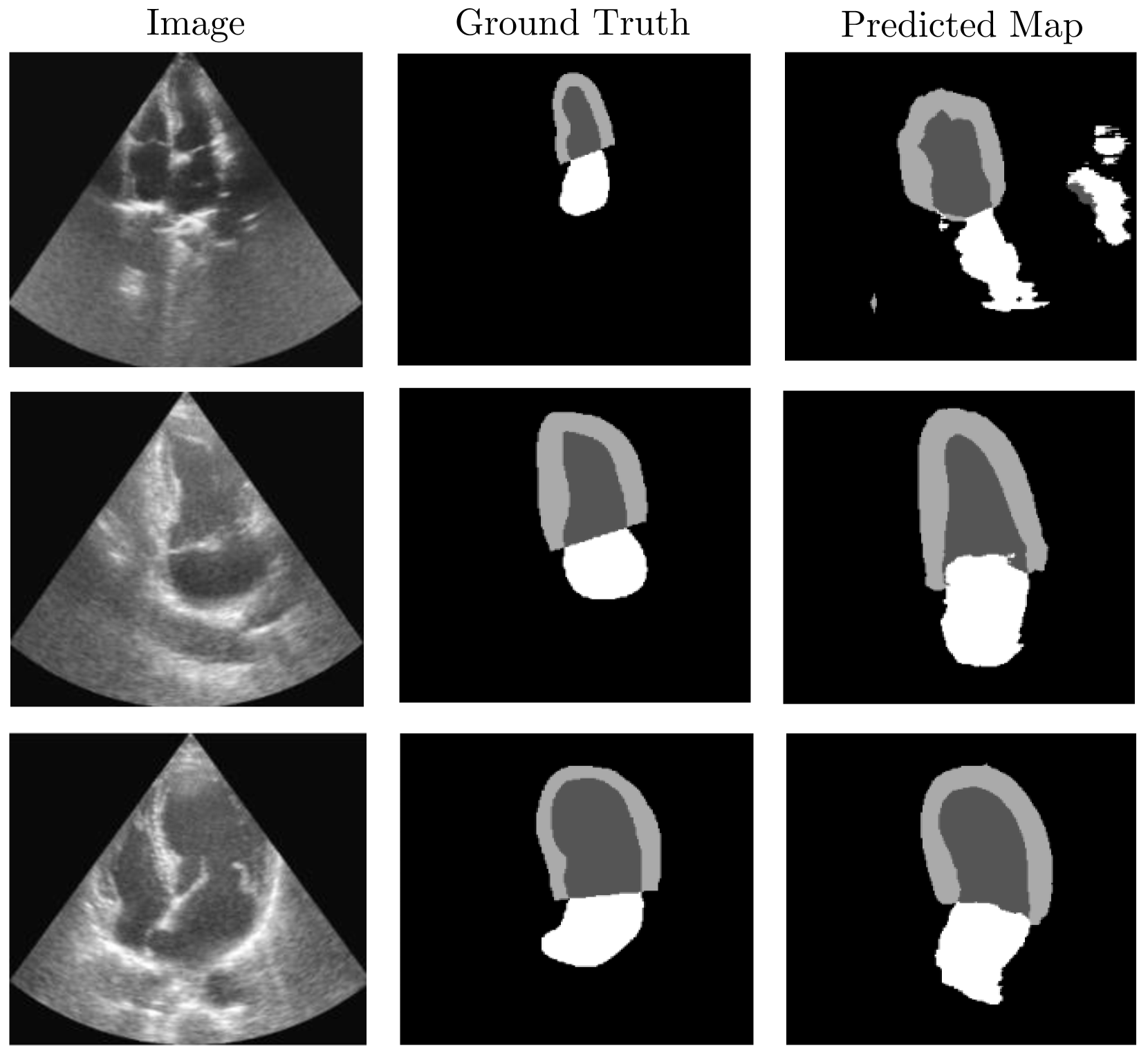 Figure 4: Illustration of some selected failure cases of our Real+100% segmentation model, highlighting specific challenges encountered during validation. In the top row, we observe a rare scenario from our validation set characterized by a small area of interest, where the model incorrectly identifies the entire surface of the Left Ventricle (LV) and Left Atrium (LA) as the LV endocardium in the predicted map. The second row illustrates a case of label confusion, where the LA label erroneously merges with the LV endocardium, leading to inaccurate segmentation. Finally, the third row shows a misguidance example, where a black circled area at the bottom of the LA has misled the model, resulting in a deviation from the correct LA label prediction. Upon examination of these phenomena, we concluded that the regions demonstrating failures are infrequently represented in the training set, which hinders the model’s ability to properly interpret text or segmentation guidance. It is noteworthy to mention that our segmentation network employs a simple, lightweight UNet architecture as our main goal was just to demonstrate the potential of the synthesized data in enhancing the performance of downstream tasks. These instances underscore the complexity of accurately modeling cardiac structures and the potential for improvement in our segmentation approach.