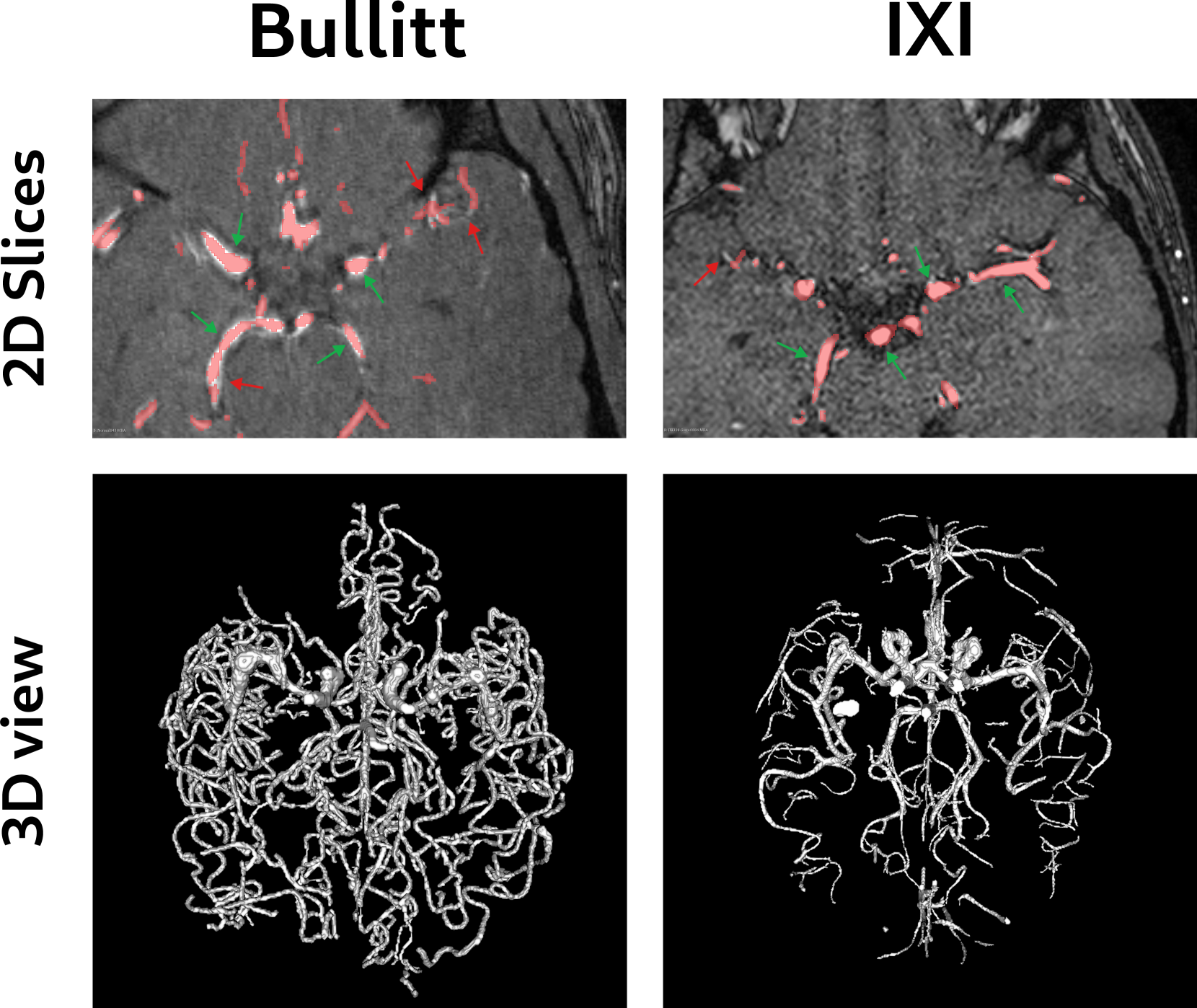 Guidelines for Cerebrovascular Segmentation: Managing Imperfect Annotations in the context of Semi-Supervised Learning