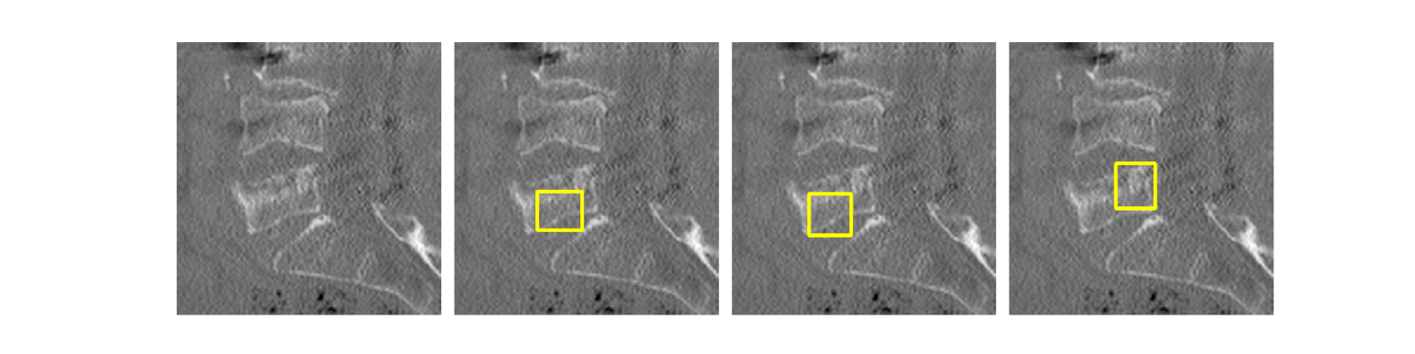 Enhancing Interpretability of Vertebrae Fracture Grading using Human-interpretable Prototypes