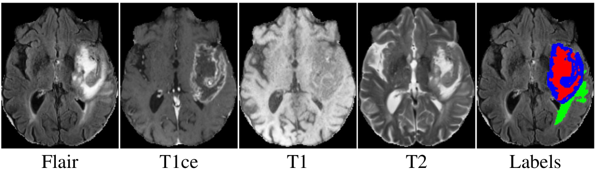 Enhancing Incomplete Multi-modal Brain Tumor Segmentation with Intra-modal Asymmetry and Inter-modal Dependency