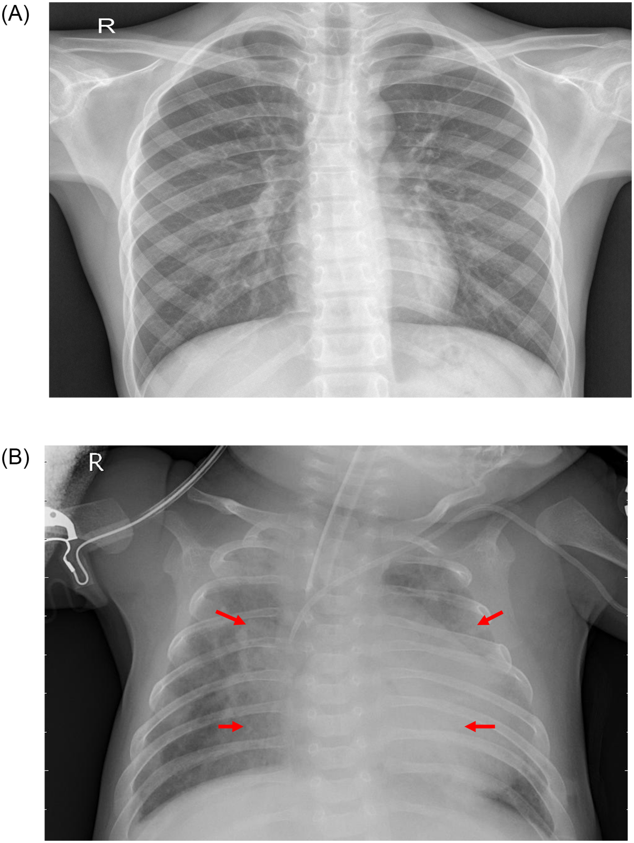 FA-Net: A Fuzzy Attention-aided Deep Neural Network for Pneumonia Detection in Chest X-Rays