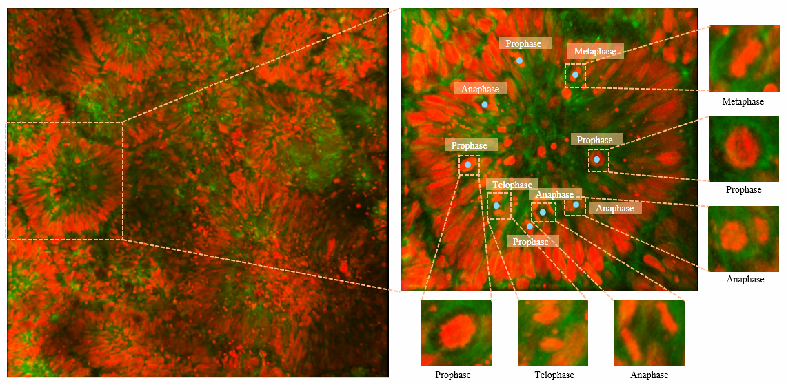 BOrg: A Brain Organoid-Based Mitosis Dataset for Automatic Analysis of Brain Diseases