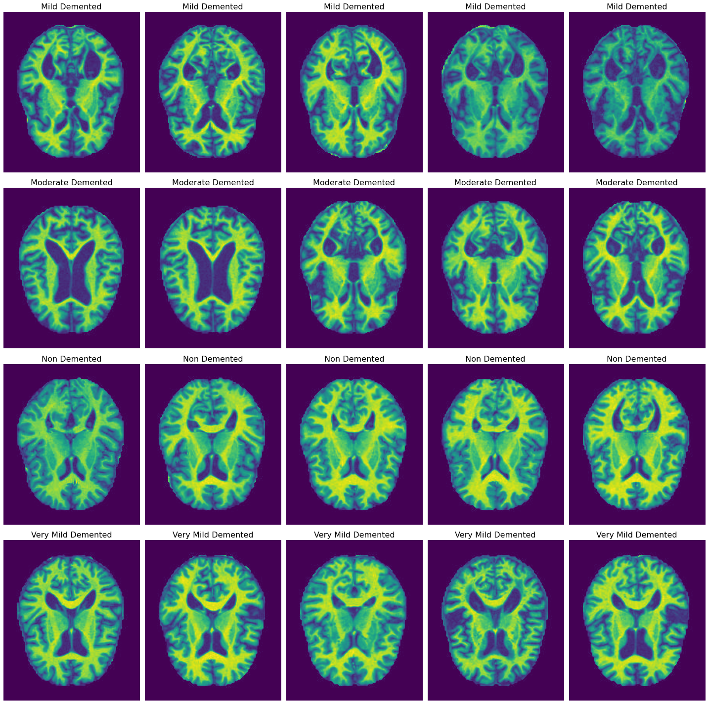 A Dual-Attention Aware Deep Convolutional Neural Network for Early Alzheimer's Detection