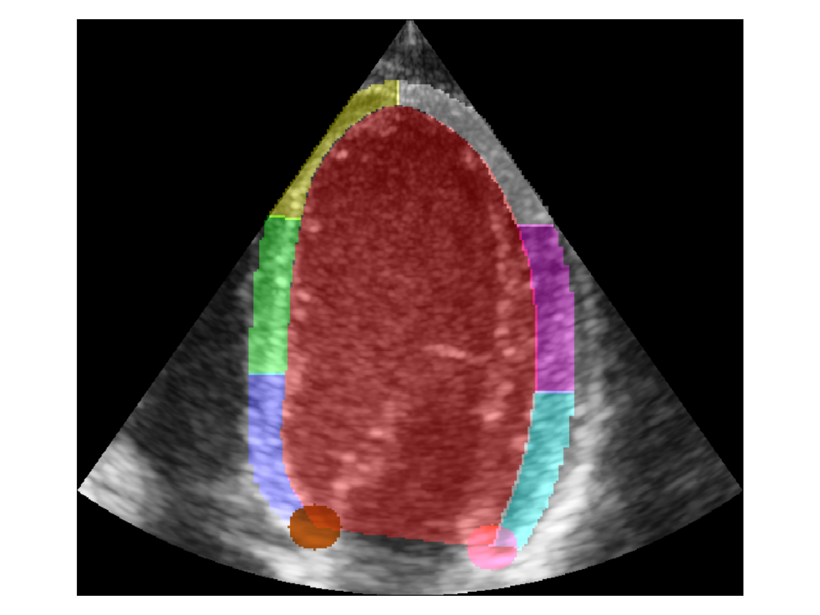 Regional quality estimation for echocardiography using deep learning