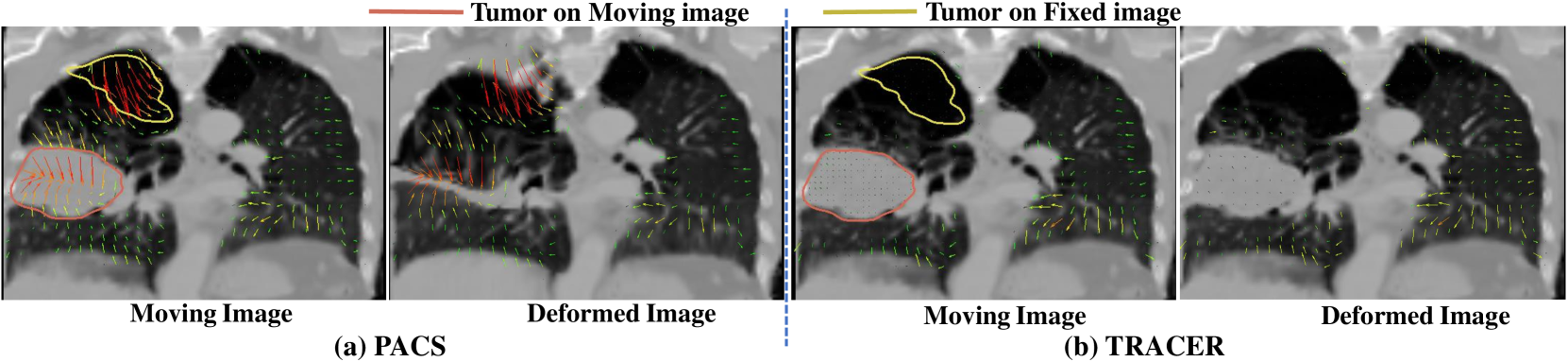 Tumor aware recurrent inter-patient deformable image registration of computed tomography scans with lung cancer