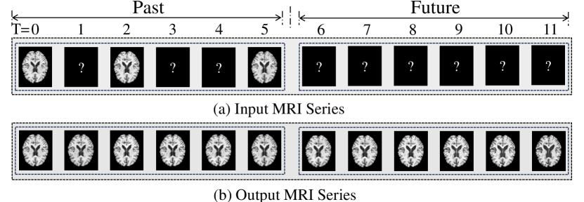 The methodology predicts the progression of Alzheimer’s disease by generating plausible future brain image sequences from past observations, effectively reconstructing missing data through interpolation and then extrapolating forward in time to forecast subsequent brain states.