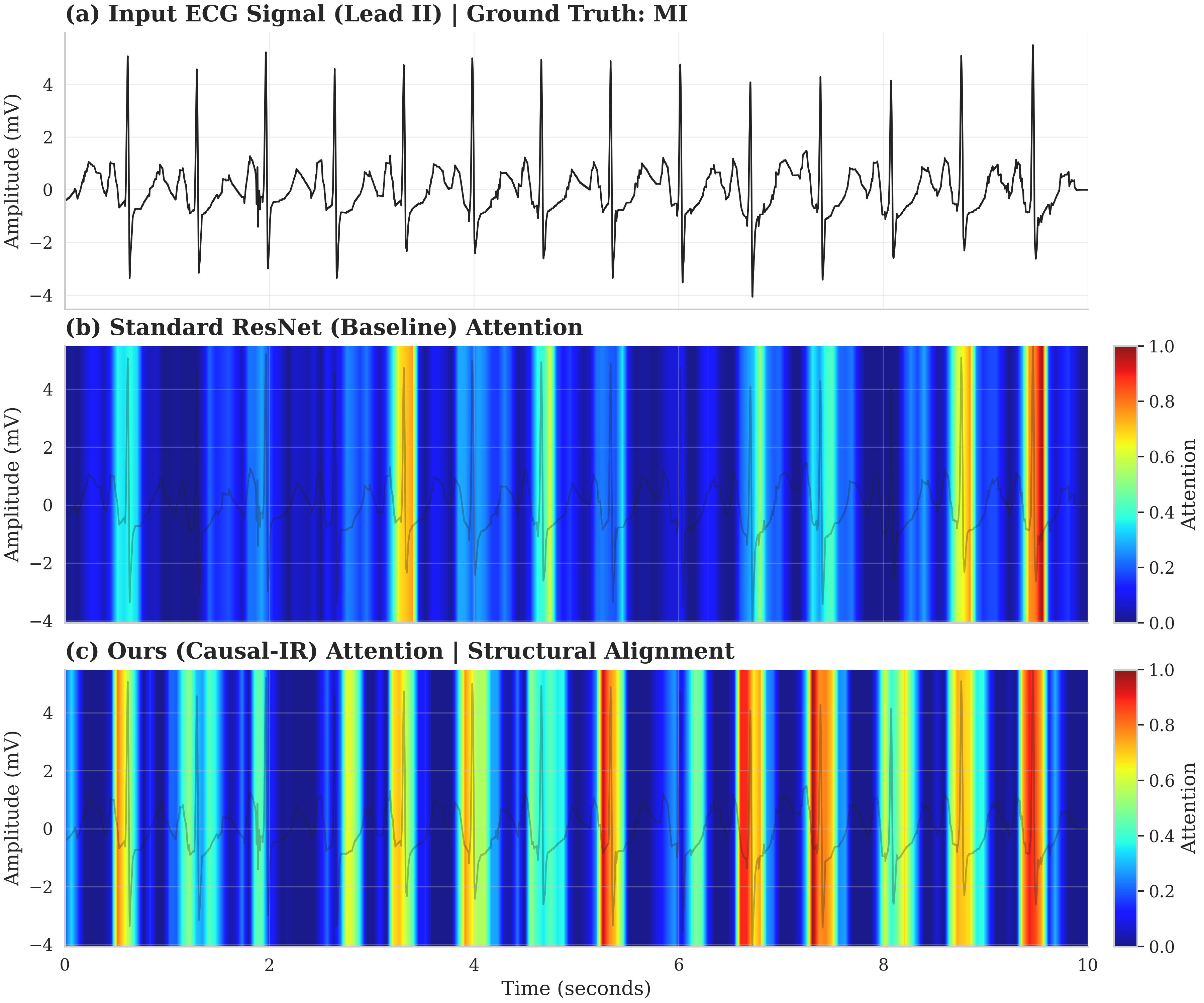 CPR attention maps effectively focus on the physiologically relevant P-QRS-T complex, unlike baseline Grad-CAM which highlights irrelevant image artifacts.