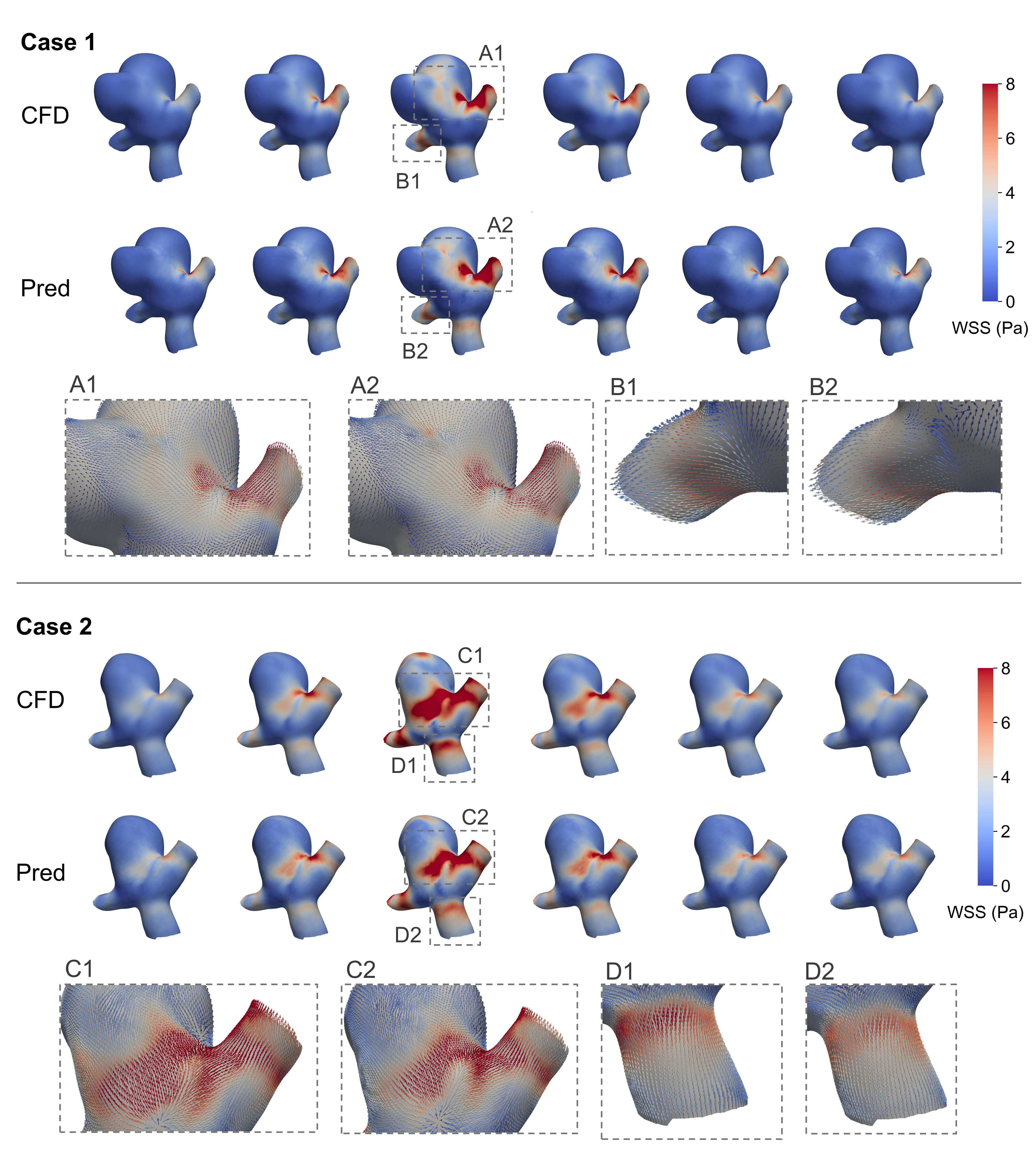 Computational fluid dynamics (CFD) and deep learning (DL) predictions demonstrate qualitatively similar transient wall shear stress (WSS) fields.