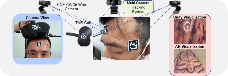 Оптическая система нейронавигации, использующая многокамерное отслеживание и дополненную реальность, повышает точность процедур транскраниальной магнитной стимуляции за счет отслеживания черно-белых оптических меток на катушке и пациенте в режиме реального времени, что позволяет осуществлять прецизионное позиционирование и идентификацию мишени посредством визуализации в Unity 3D.