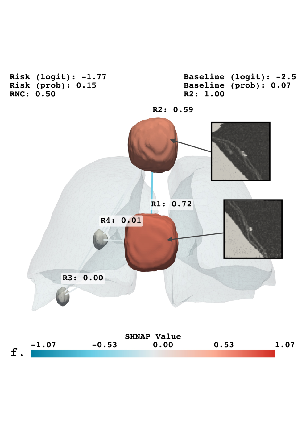 SHNAP explanations reveal attribution magnitudes for Sybil's predictions across patients, highlighting differences between benign and malignant nodules based on local fidelity (<span class="katex-eq" data-katex-display="false">R2R^{2}</span>) and relative normalized contribution (<span class="katex-eq" data-katex-display="false">RNC</span>).