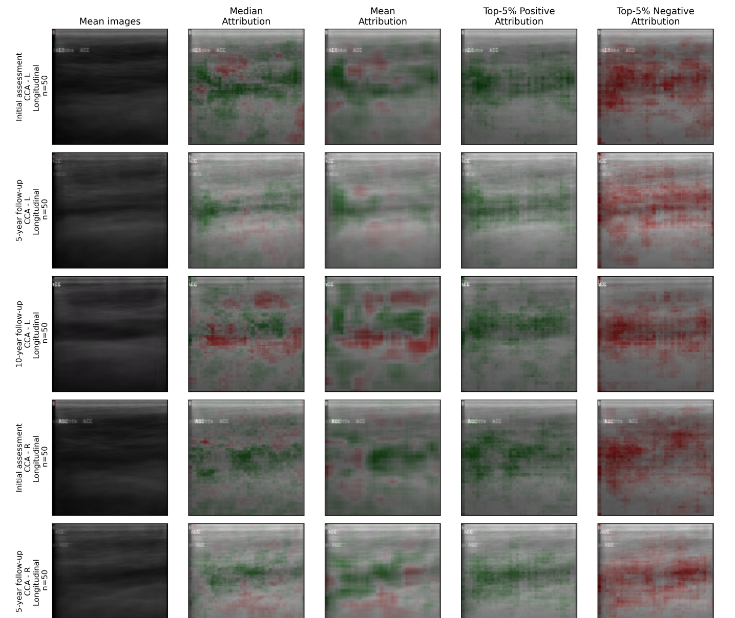 The study reveals that while vessel walls consistently register as key indicators of vascular damage, the significance of perivascular tissue as a diagnostic region intensifies with time-particularly evident in assessments conducted after a decade of observation-suggesting a progressive shift in the physiological markers of vascular degeneration.