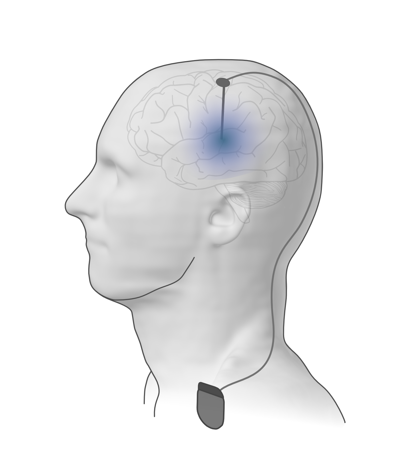 Инвазивная глубокая стимуляция мозга (DBS) предполагает имплантацию электродов, соединенных с генератором импульсов, для создания электрических полей, стимулирующих целевые области мозга.