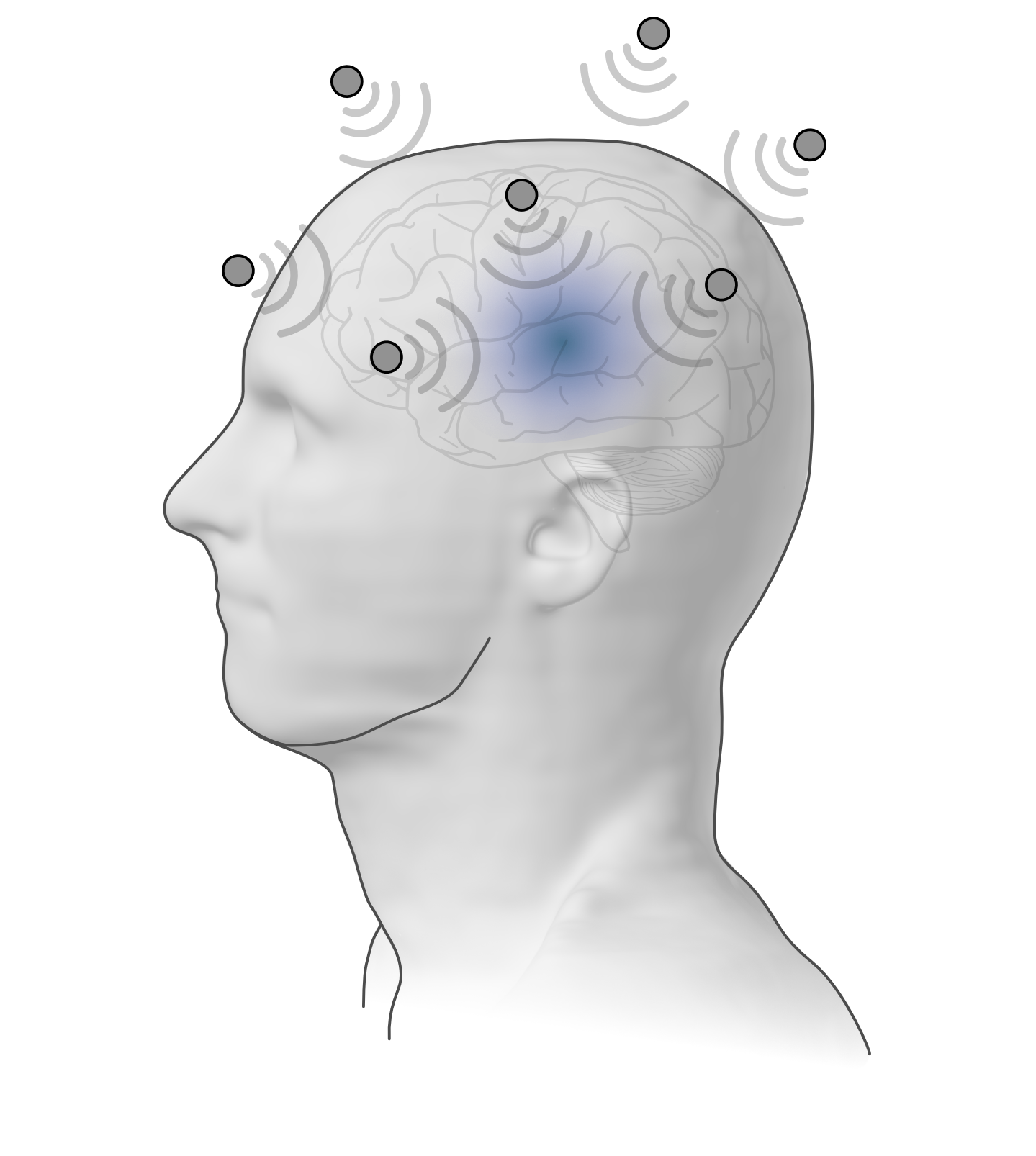 Предлагаемый неинвазивный метод глубокой стимуляции мозга использует внешнюю антенную решетку микроволнового излучения для фокусировки электрических полей, индуцирующих нейронную стимуляцию в заданной области мозга, открывая путь к терапии без хирургического вмешательства.